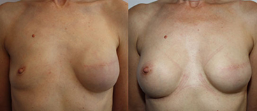 De gauche à droite :  Après mastectomie et  prothèse d’expansion Après augmentation controlatérale