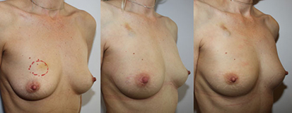 De gauche à droite :  Tumeur de 30mm  avant CNA Fonte de la lésion  et résultat après chirurgie conservatrice Résultat final après radiothérapie