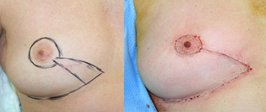 De gauche à droite :  localisation inférointerne: exérèse  avec une incision sous mammaire  permettant un lambeau   résultat  per-opératoire  après lambeau cutanéoglandulaire et round block associé