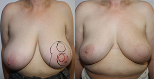 De gauche à droite :  Tumeur rétroaréolaire en préopératoire après chirurgie  et radiothérapie