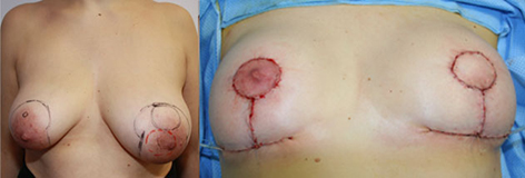 De gauche à droite :  Tumeur rétroaréolaire en préopératoire résultat en fin d’intervention