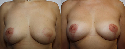 De gauche à droite :  après chirurgie  et radiothérapie après reconstruction aréolo-mamelonnaire