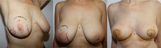 De gauche à droite :  cancer inféroexterne aspect préopératoire résultat au 15è jour  post opératoire