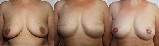 De gauche à droite :  Anomalie BRCA , seins  ptosés Mastectomie totale bilatérale  avec prothèses Résultat après  reconstruction des aréoles 